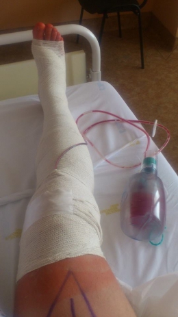 Pohled na odoperované koleno s drenáží  